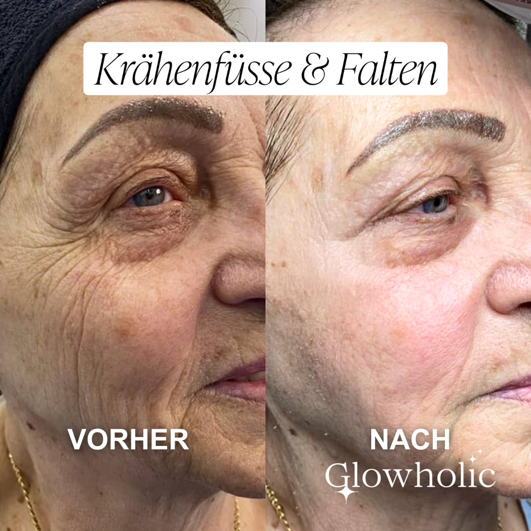 Glowholic Micro-Needling Infusion Anti-Aging Nachfüll-Seren